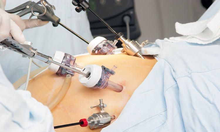 Laparoscopic Gynaecology Surgeries